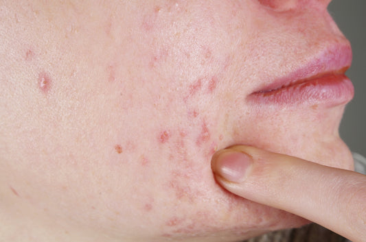 How Can LED Light for Acne Help?