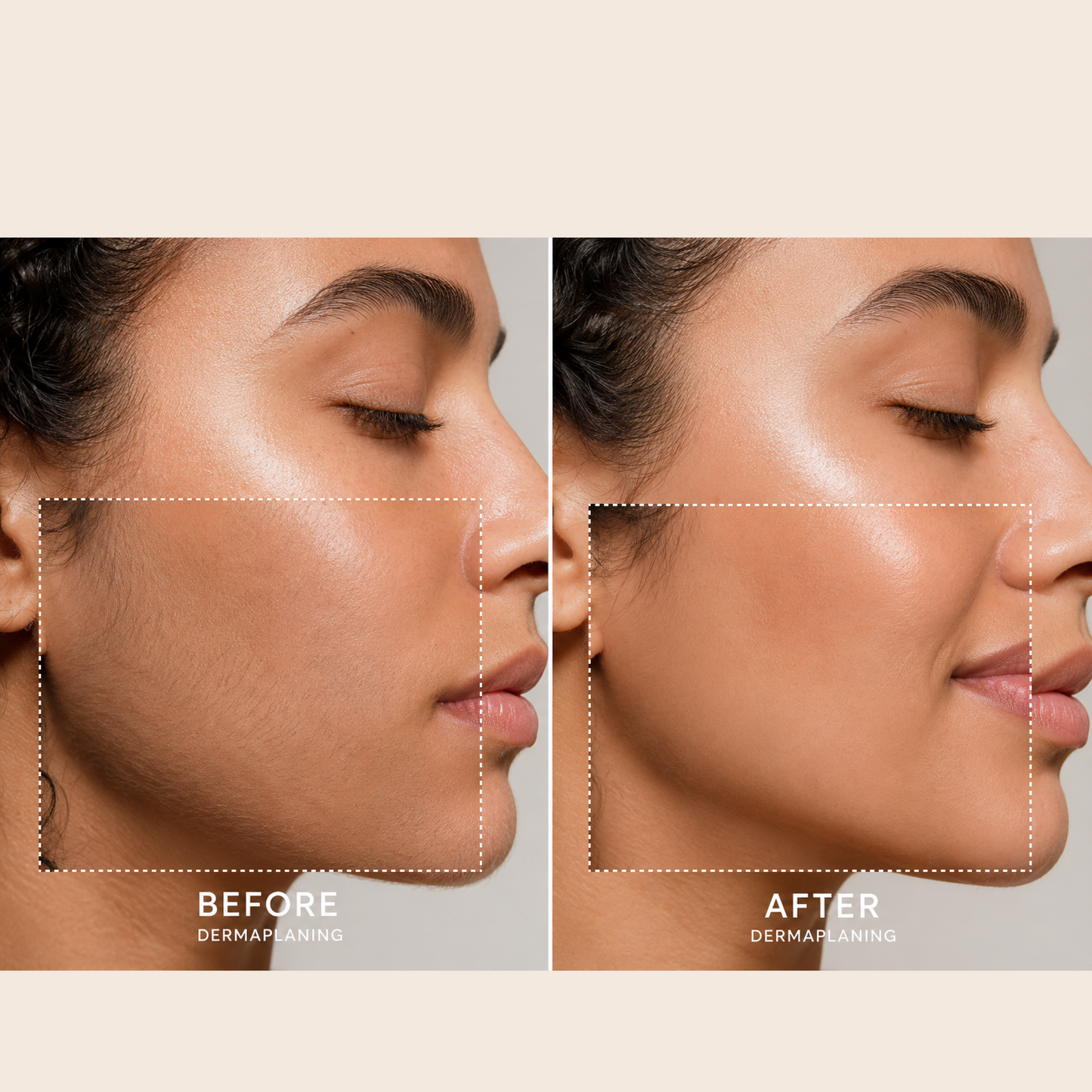 Side-by-side photos of a womanโs face before and after using the Spa Sciences SIMA Deluxe Kit, highlighting smoother, hair-free skin in the โafterโ image compared to the โbeforeโ image.