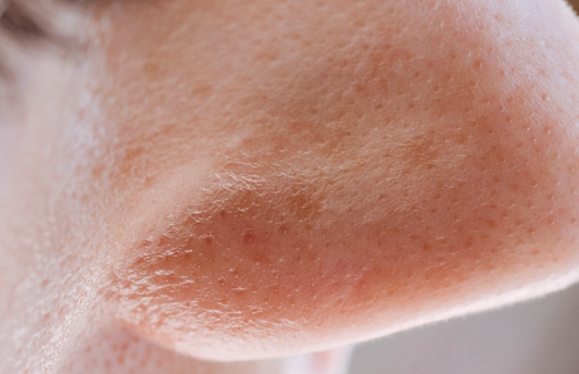 Skin Sciences: What is Pore Extraction?