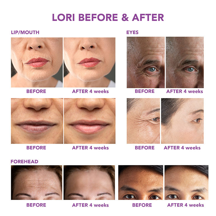 Lori's skin improved significantly after using the Spa Sciences sonic wand to promote blood circulation, reducing fine lines.