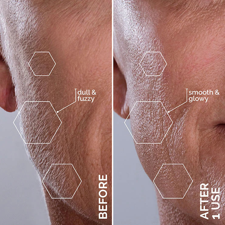 A man's face before and after a laser treatment using Spa Sciences SIMA Deluxe Dermaplaning Kit with sonic technology.