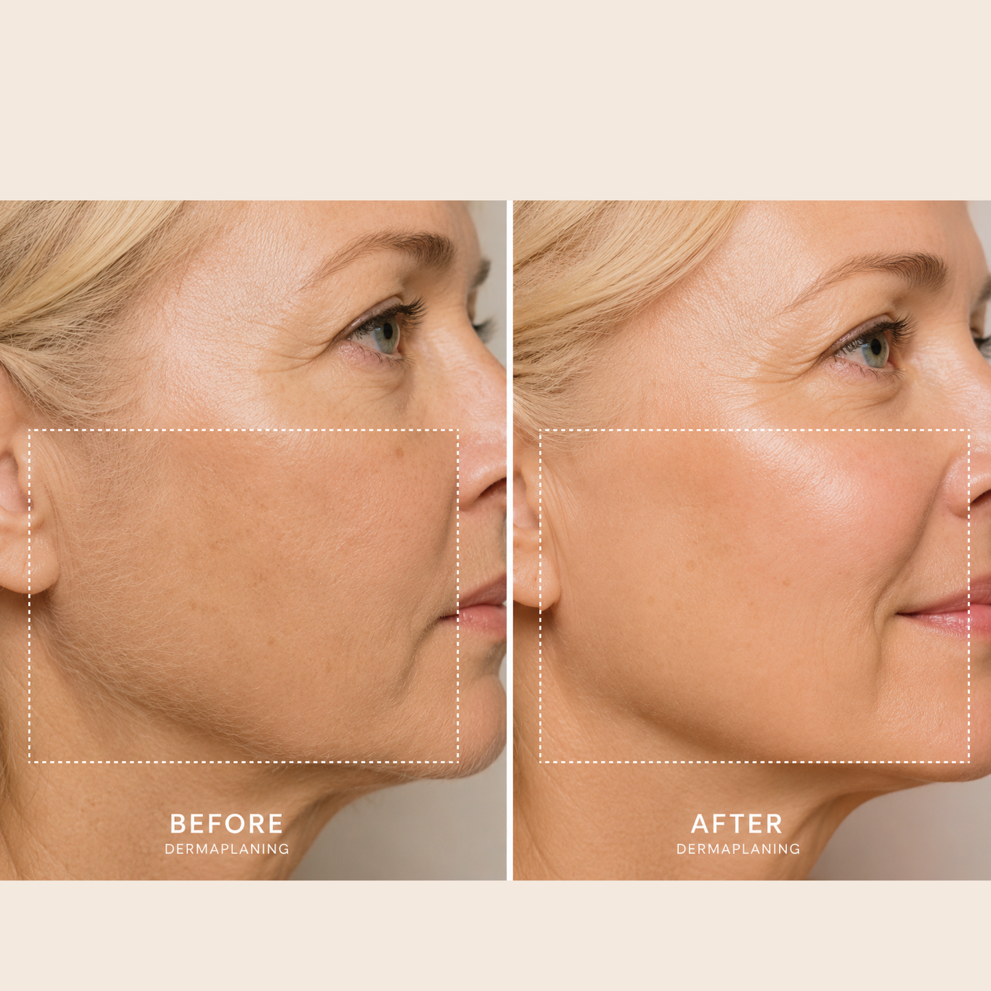 Side-by-side photos of a woman’s face show skin texture before and after using the Spa Sciences SIMA Deluxe Kit for dermaplaning; in the “after” image, her complexion appears noticeably smoother and more radiant.