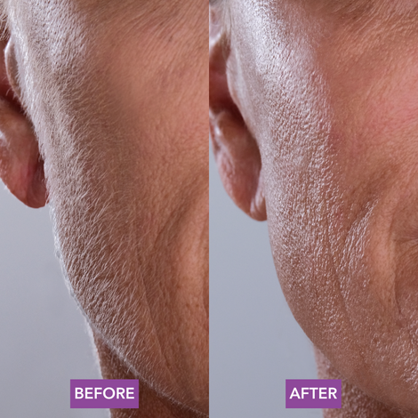A woman's face with wrinkles before and after Spa Sciences' SIMA Deluxe Dermplaning treatment.