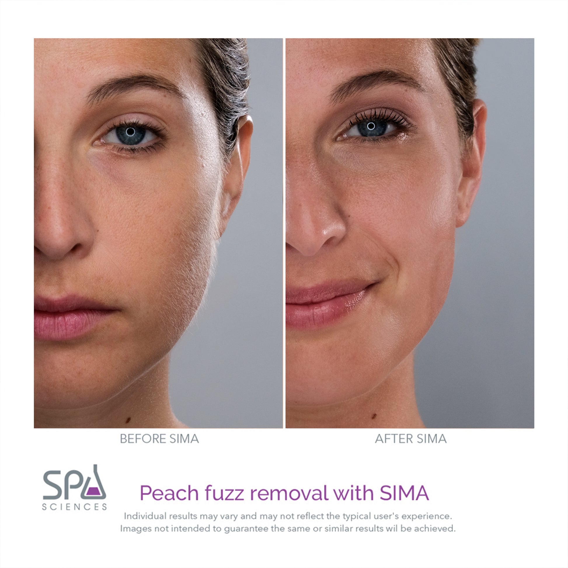 Peach fuzz removal with the Spa Sciences SIMA Deluxe Kit.