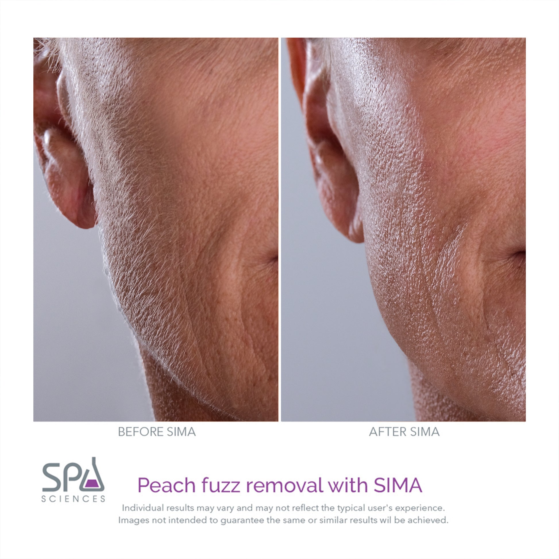 Peach fuzz removal with Spa Sciences SIMA Deluxe Kit.