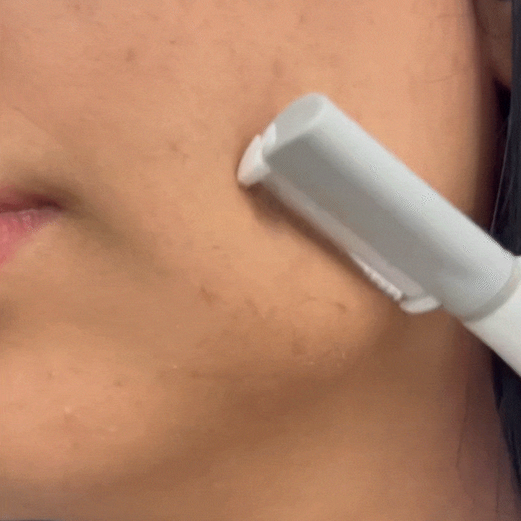 A woman is using the Spa Sciences SIMA Deluxe Kit on her face.